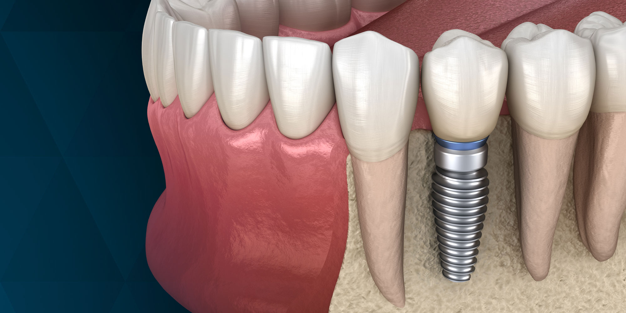 Implant Integration