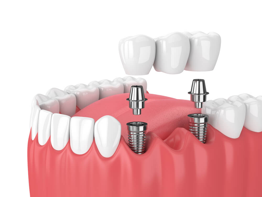 Dental Bridges or Implants