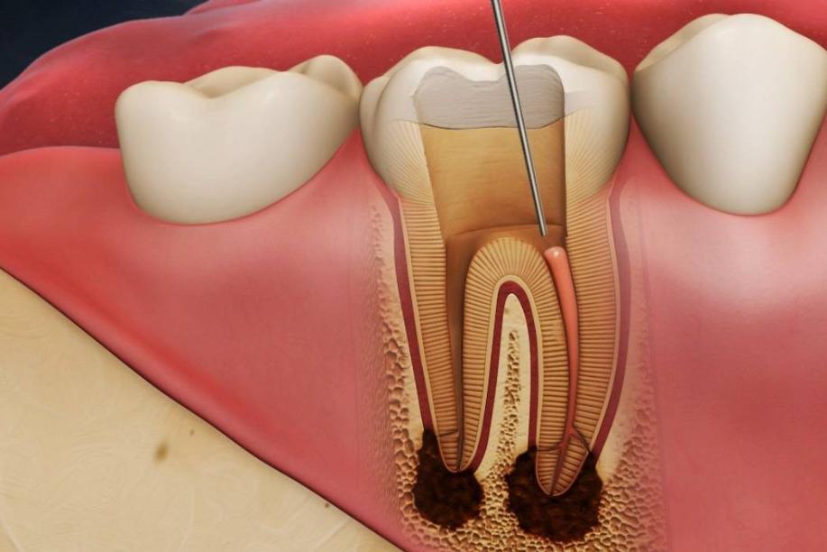 Symptoms indicating the development of pulpitis