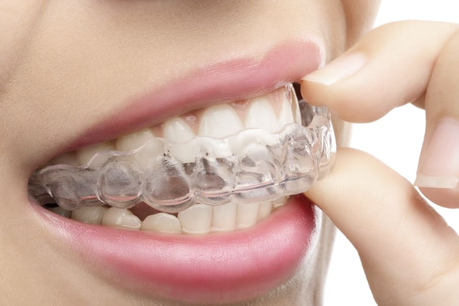 Invisible Aligners