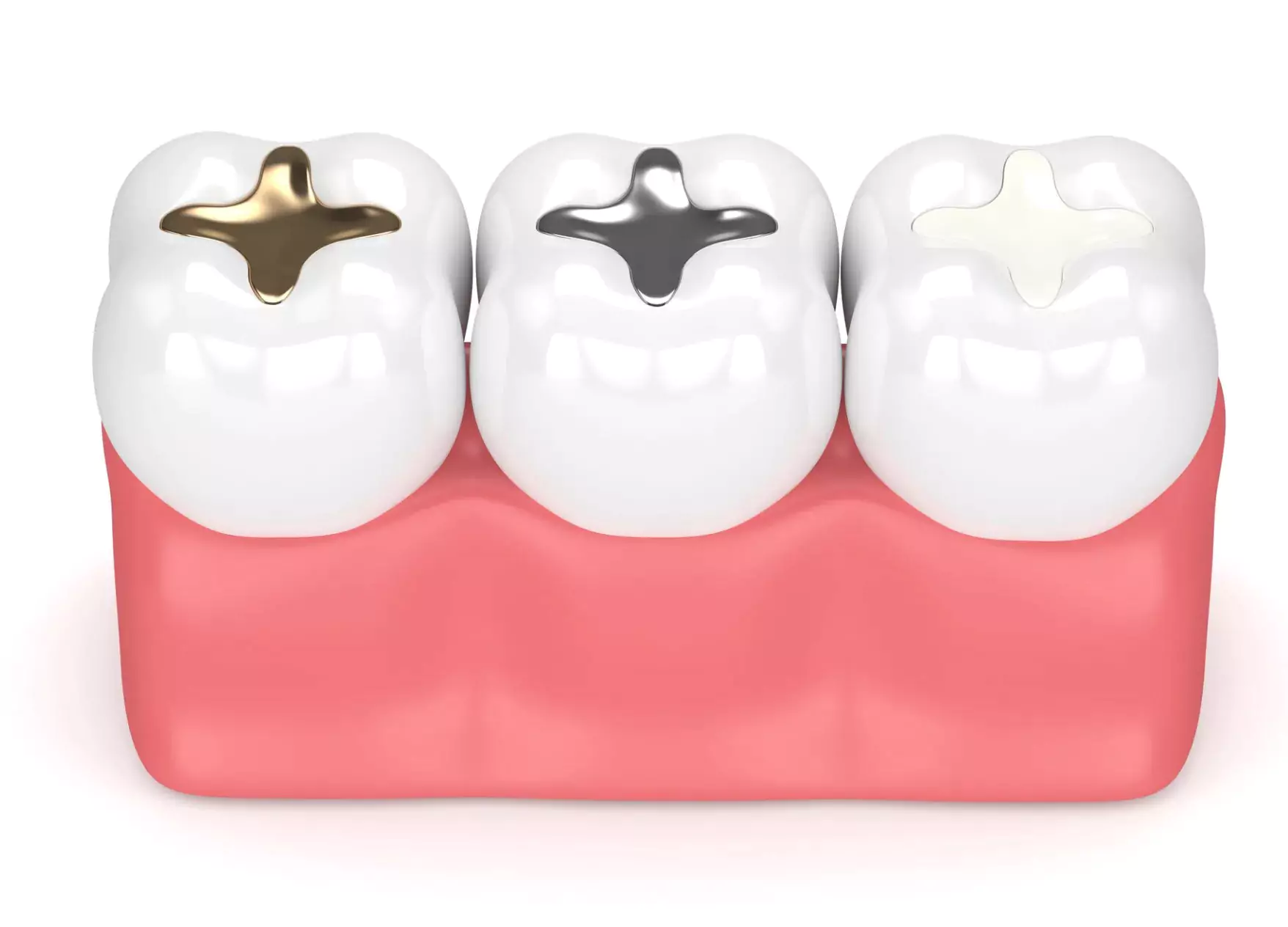 Types of Dental Fillings